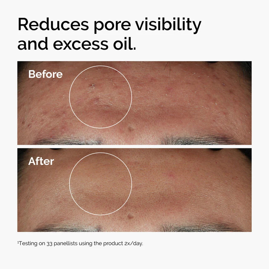 The Ordinary Niacinamide 10% + Zinc 1% – Suero Anti-Imperfecciones 30 ml