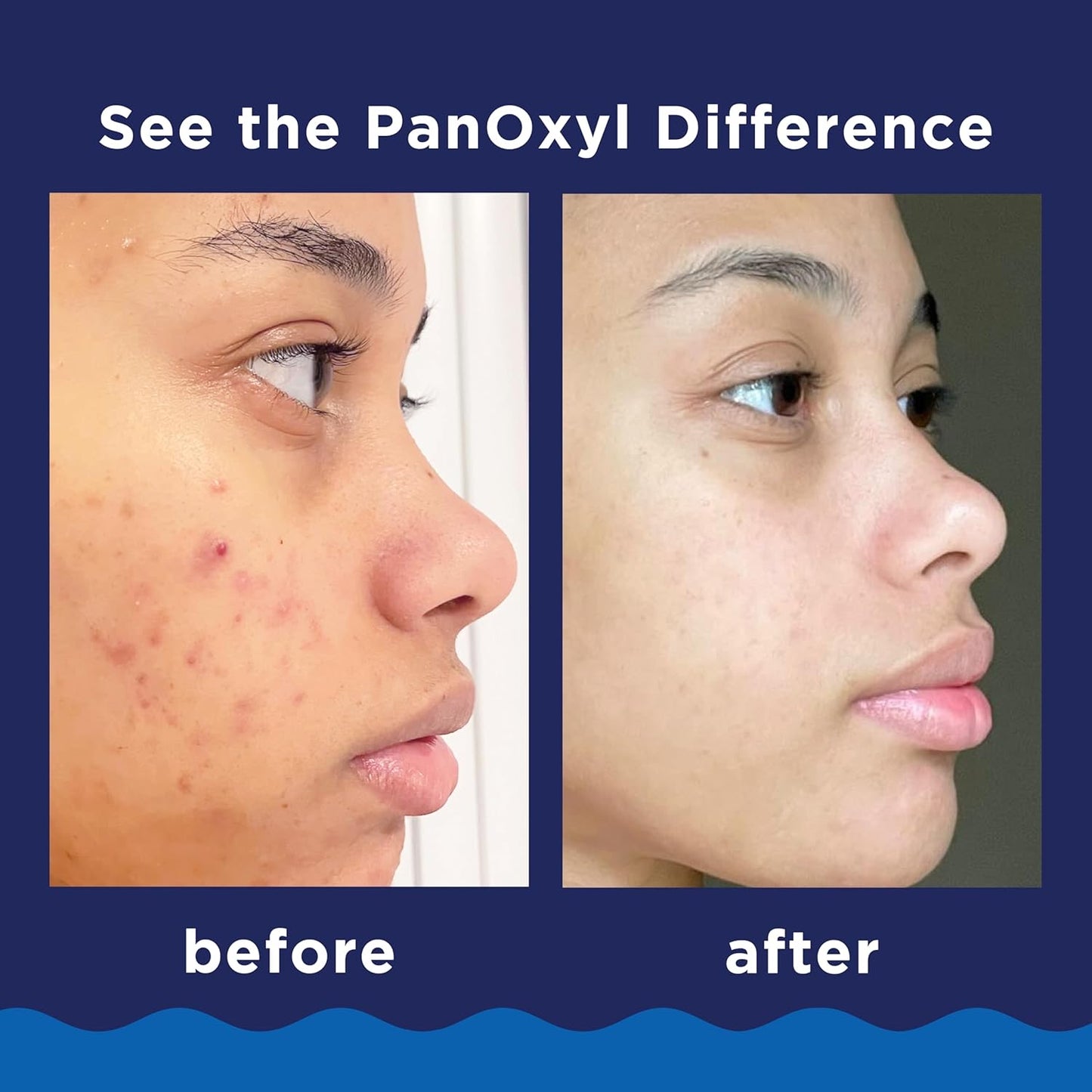 PanOxyl Acne Foaming Wash 10% Benzoyl Peroxide – Limpiador Facial y Corporal Antiacné (156 g)